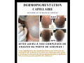 dermopigmentation-capillaire-pour-camoufler-votre-calvitie-small-3