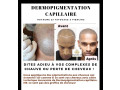 dermopigmentation-capillaire-pour-camoufler-votre-calvitie-small-0