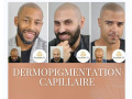 dermopigmentation-capillaire-pour-camoufler-votre-calvitie-small-5