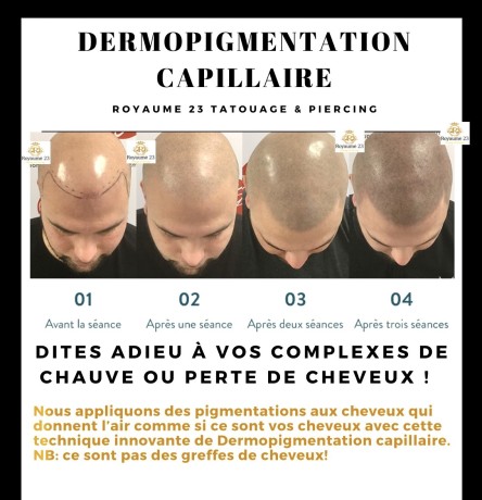 dermopigmentation-capillaire-pour-camoufler-votre-calvitie-big-2
