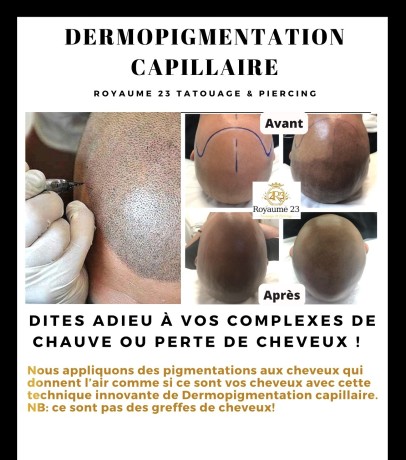 dermopigmentation-capillaire-pour-camoufler-votre-calvitie-big-3