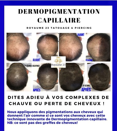 dermopigmentation-capillaire-pour-camoufler-votre-calvitie-big-1