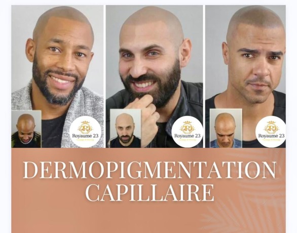 dermopigmentation-capillaire-pour-camoufler-votre-calvitie-big-5