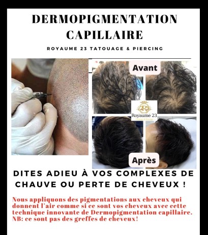 dermopigmentation-capillaire-pour-camoufler-votre-calvitie-big-4