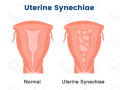 traitement-naturel-de-la-synechie-uterine-small-3