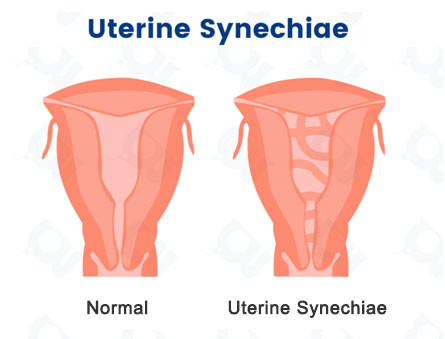traitement-naturel-de-la-synechie-uterine-big-3