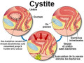 traitement-naturel-de-la-cystite-small-2