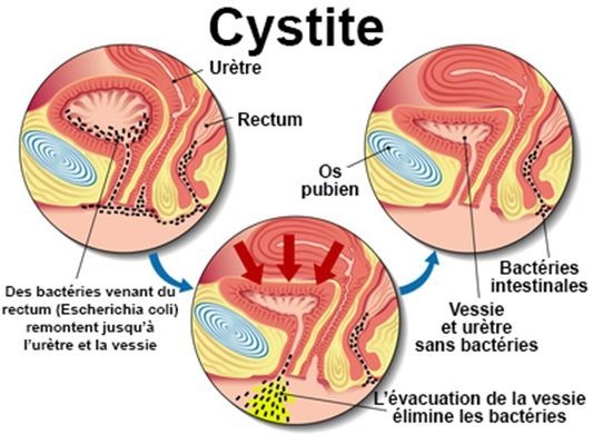 traitement-naturel-de-la-cystite-big-2