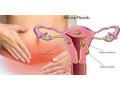 traitement-naturel-contre-les-fibromes-uterins-small-3