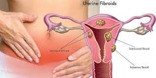 traitement-naturel-contre-les-fibromes-uterins-big-3